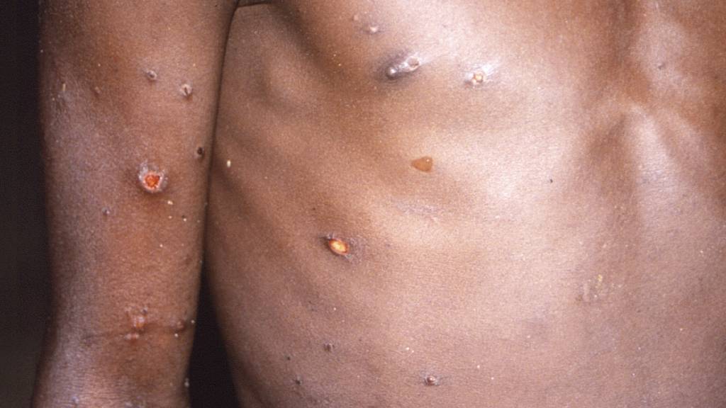 WHO ruft wegen Mpox weltweite Notlage aus