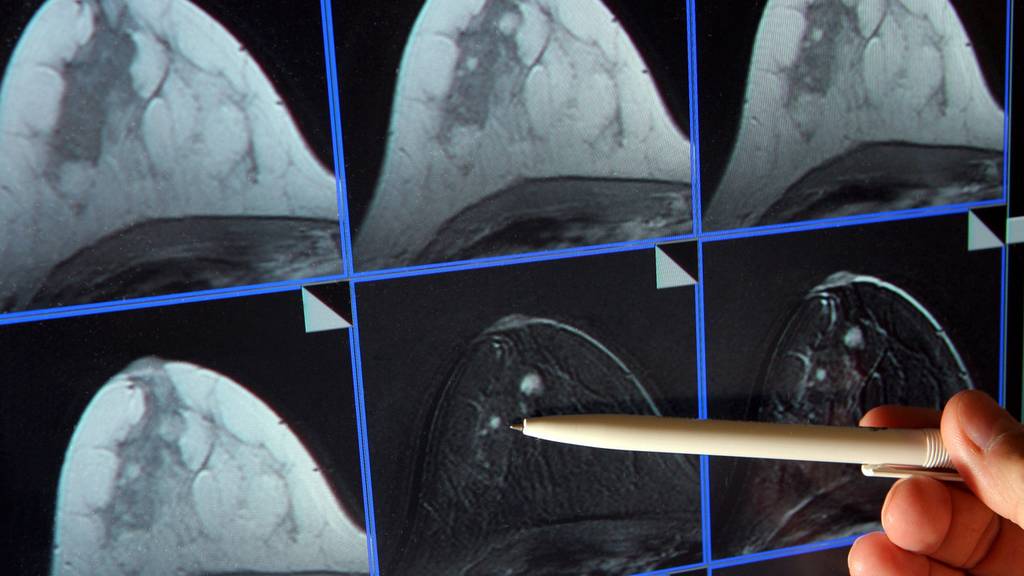 Früherkennung von Brustkrebs