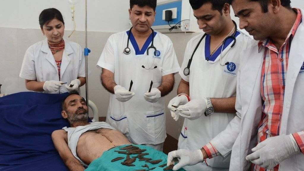 Ein indischer Polizist hat innert zwei Monaten 40 Messer geschluckt. Nach einer fünfstündigen Operation konnten ihn die Ärzte von der Masse im Magen befreien.