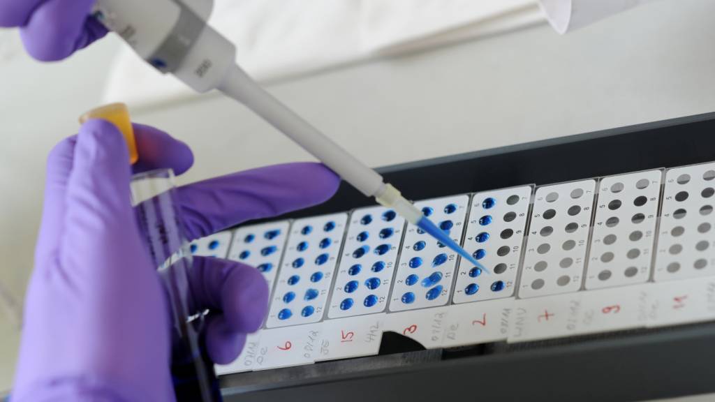 ARCHIV - Ein Medizinisch Technischer Assistent (MTA) detektiert eine Antigen-Antikörper-Reaktion (Symbolbild). Foto: Angelika Warmuth/dpa