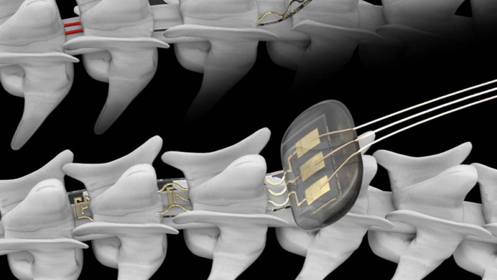 An der Lausanner EPFL wurde ein Implantat entwickelt, mit dem via Bluetooth die Aktivität von Nervenzellen im Rückenmark gesteuert werden kann (Pressebild).