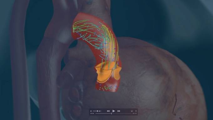 EPFL-Forscher arbeiten an virtuellem Patientenherz