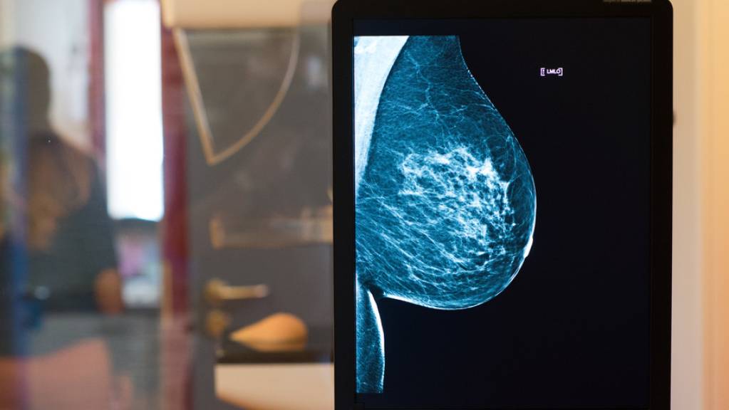 Sensible Daten aus Mammographie-Screenings oder anderen medizinischen Untersuchungen sind auf ungeschützten Servern gelandet und damit frei zugänglich. Laut einem Bericht sind auch zwei Systeme in der Schweiz betroffen. (Archivbild)