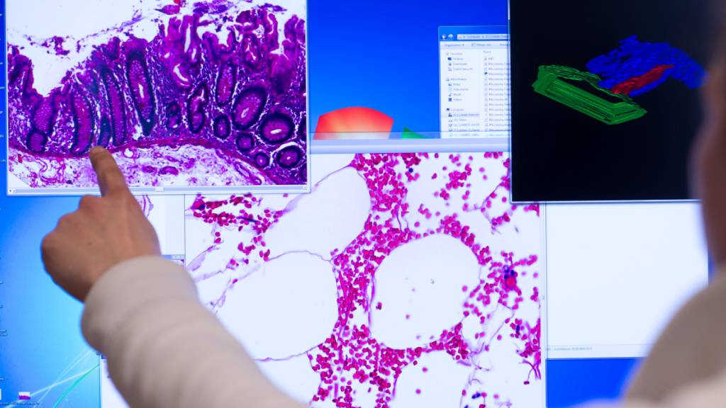 Ein Mitarbeiter zeigt an einem Computerbildschirm auf eine Darstellung einer eingescannten Probe eines Stück Gewebes aus dem Dickdarm, das bei einer Operation entnommenen wurde. (Symbolbild)