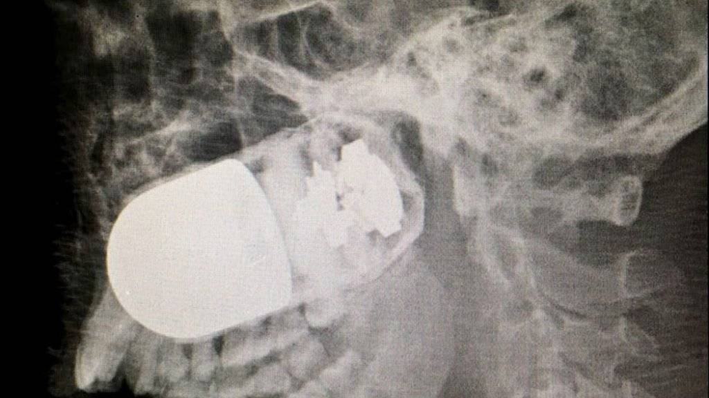 Geschoss im Schädel: Ärzte in Kolumbien entfernten die scharfe Granate erfolgreich aus dem Kopf eines Soldaten.