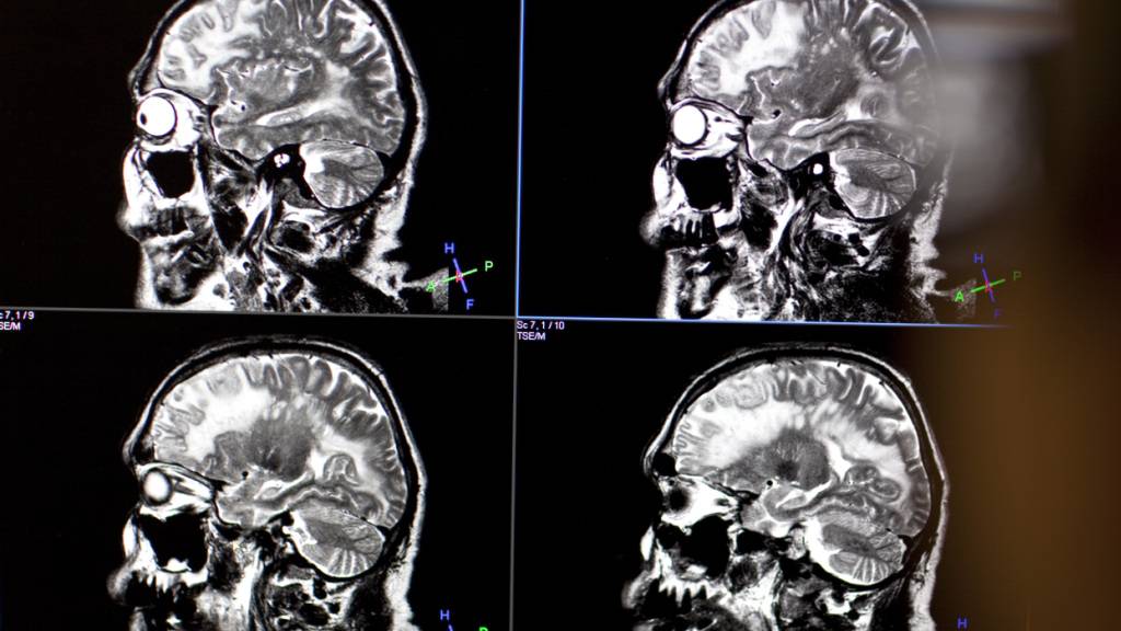 Genfer Forschende finden neuen Ansatz gegen Schizophrenie-Symptome