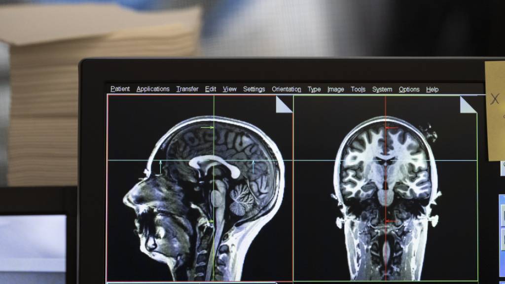 Mit einem Magnetresonanztomographen (MRT) lassen sich in Gehirnen von Schmerzpatienten Veränderungen nachweisen. (Symbolbild)