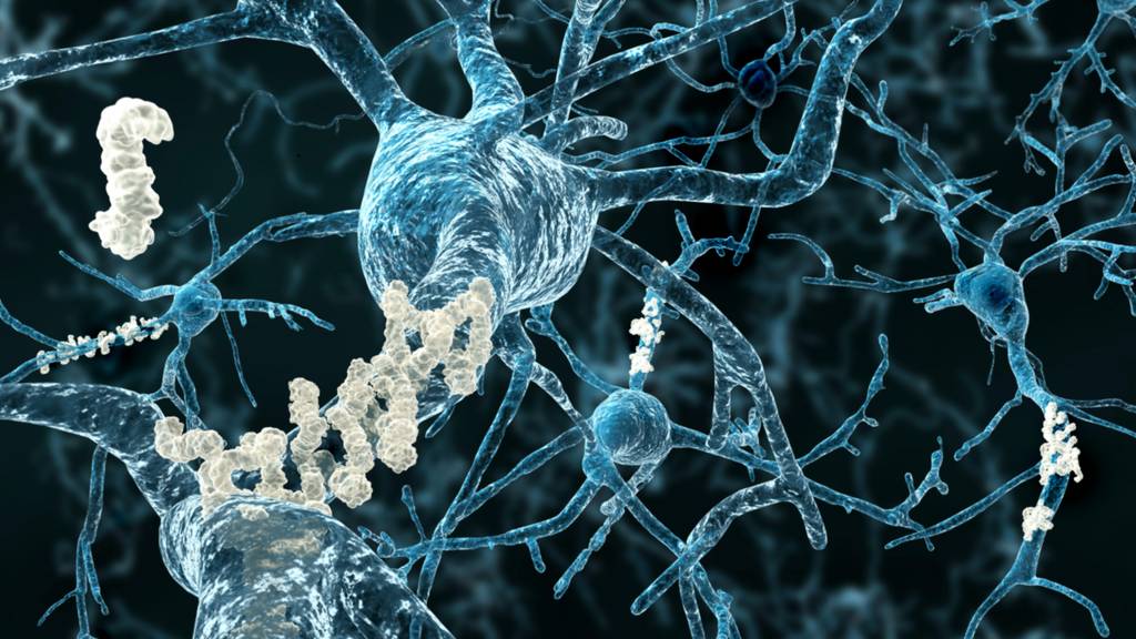 Meistzitierte Studie zu Alzheimer ist wahrscheinlich gefälscht