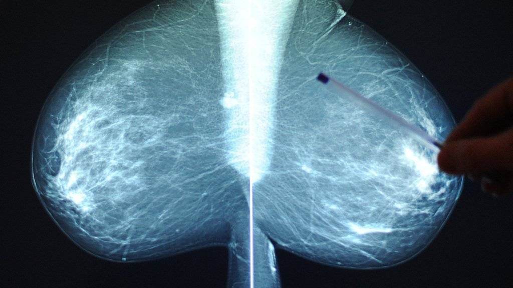 Die Röntgenaufnahme der Brust wird beim Mammografie-Screening von zwei Fachpersonen unabhängig geprüft. (Symbolbild)