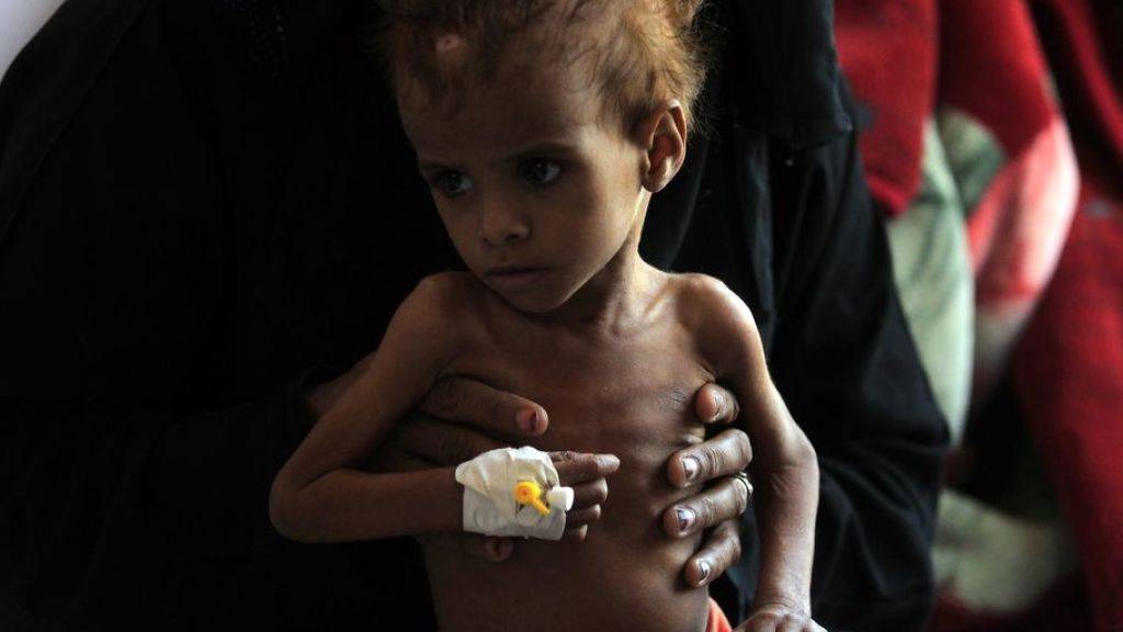 Ein jemenitisches Kind wird wegen Unterernährung in einem Spital in Sanaa behandelt. (Archivbild)
