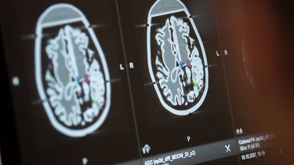 Elon Musks Firma Neuralink, die das Gehirn mit Hilfe von Implantaten mit einem Computer verbinden will, hat sich frisches Geld bei Investoren besorgt. (Symbolbild)
