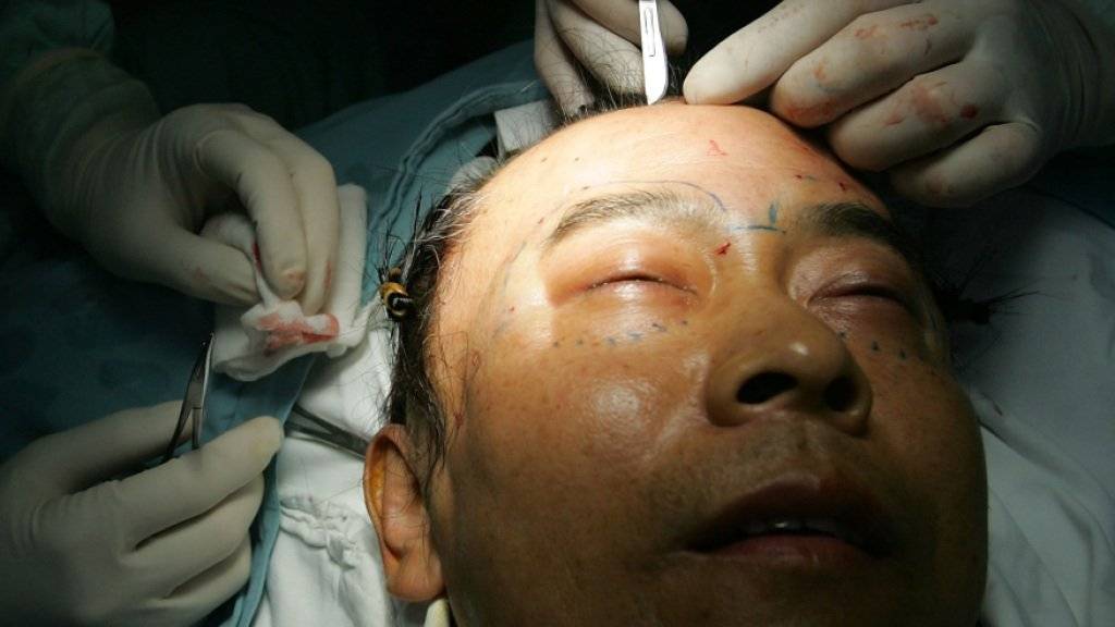 Streckung der Augenlider, Fettabsaugen und Gynäkomastie: Diese chirurgischen Eingriffe verlangen brasilianische Männer am häufigsten. (Symbolbild)