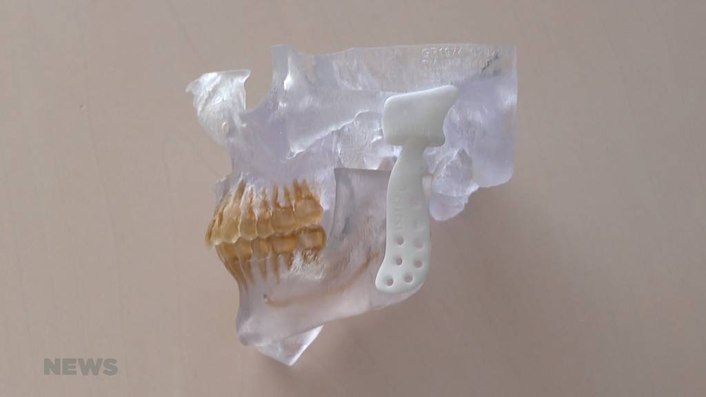 Seltene Kieferoperation in Bern: Patient erhält dank 3D-Technik neues Kiefergelenk