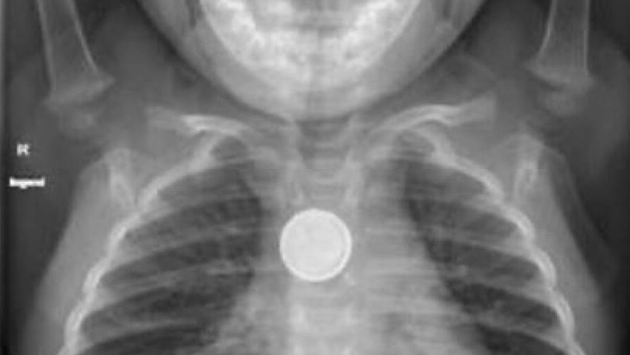 Kann verheerende Folgen haben: Verschluckte Knopfbatterie im Röntgenbild eines kleinen Kindes.