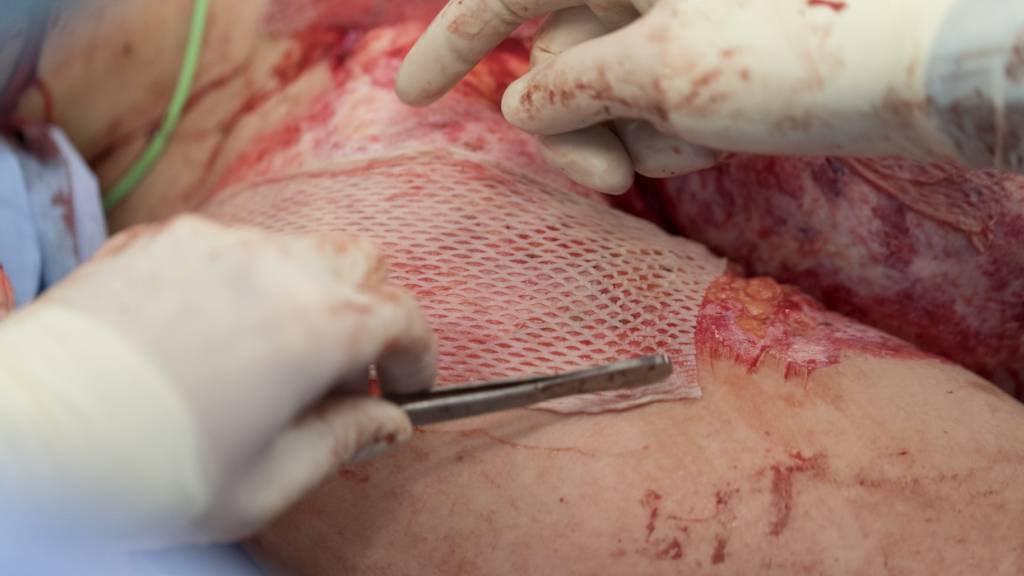 Geschlechterunterschied bei Brandverletzungen überrascht Forschung