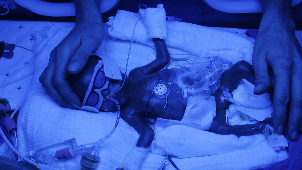 Ein frühgeborenes Baby, das auf einer Intensivstation mit Blaulicht bestrahlt wird: Eine Studie zerschlägt die Hoffnungen, dass die Gabe des Hormons EPO den Frühchen hilft.